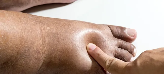 A finger pressing into a swollen foot, leaving a dent