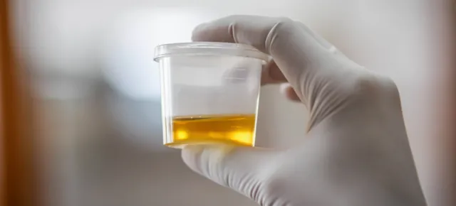 A urine sample held up to the light