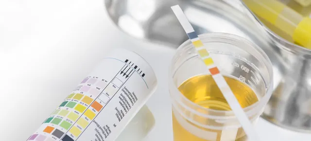 A urine test strip next to a colour chart